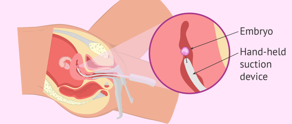 Surgical Abortion in Nepal