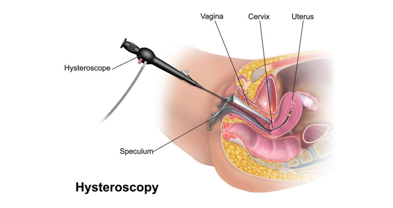 Hysteroscopy: A Gynecologist’s Guide