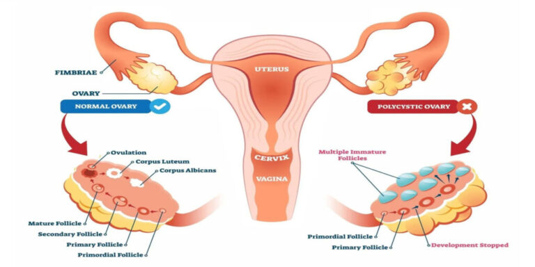 All about PCOD, or Polycystic Ovarian Disease