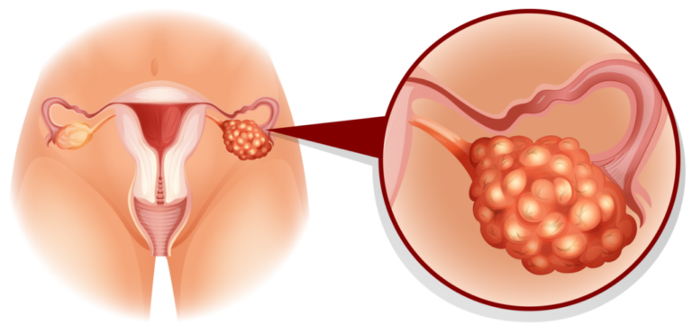 Polycystic ovary syndrome (PCOS) – Symptoms, causes and Cure