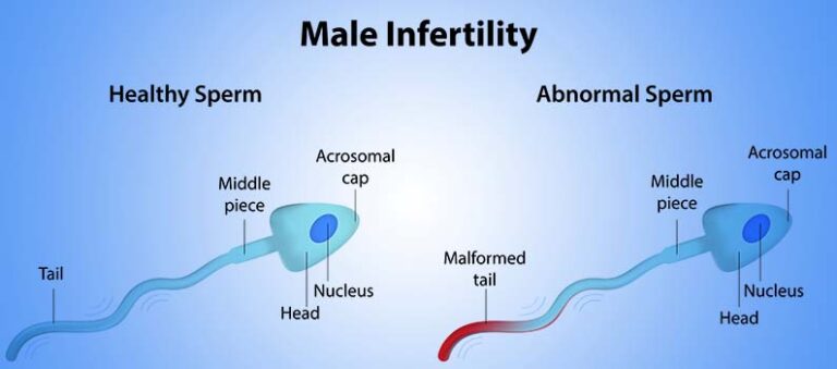 Male infertility in Nepal