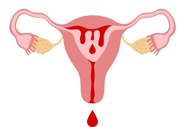 Abnormal Uterine Bleeding: A Simple Guide