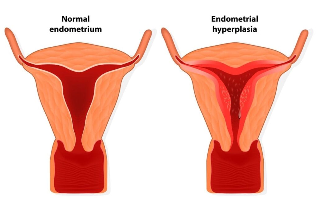 Endometrial Thickening: Causes, Symptoms, Treatment, and Prevention