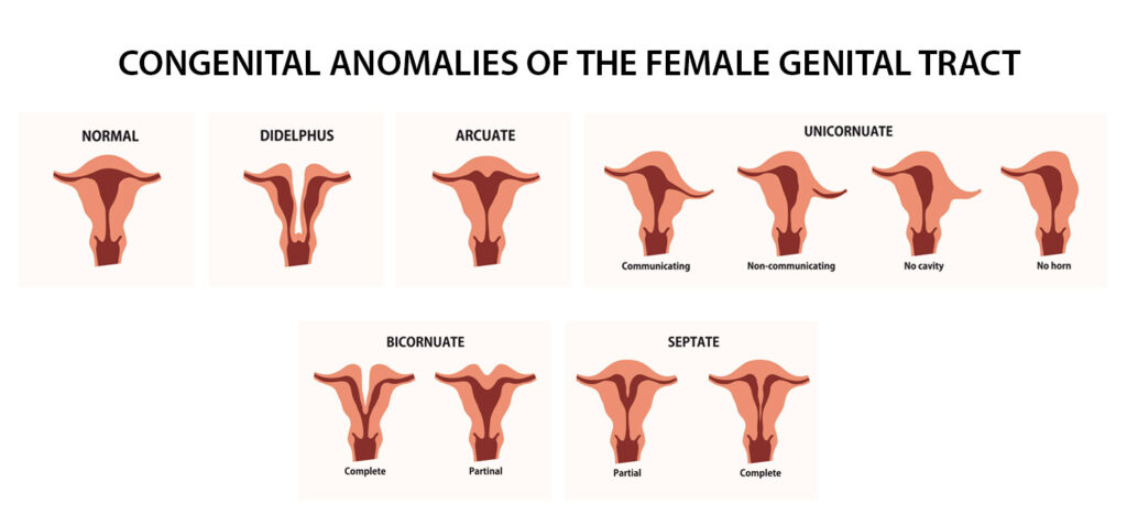 Müllerian Congenital Anomalies: Insights into Women's Reproductive Health