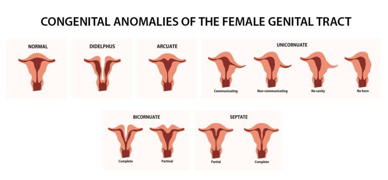 Müllerian Congenital Anomalies: Insights into Women’s Reproductive Health