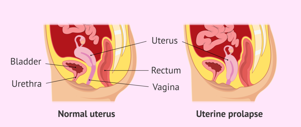 Uterine Prolapse in women: Causes, Symptoms and Treatments