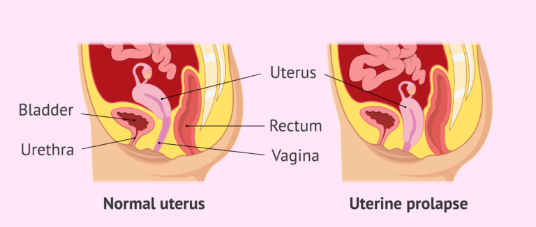 Understanding Uterine Prolapse (aang khasnu) in Women