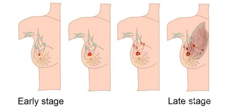 Breast cancer in Nepal