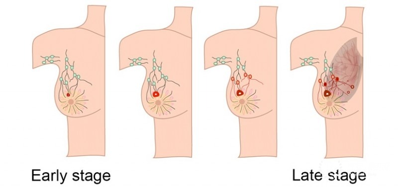 Breast cancer in Nepal