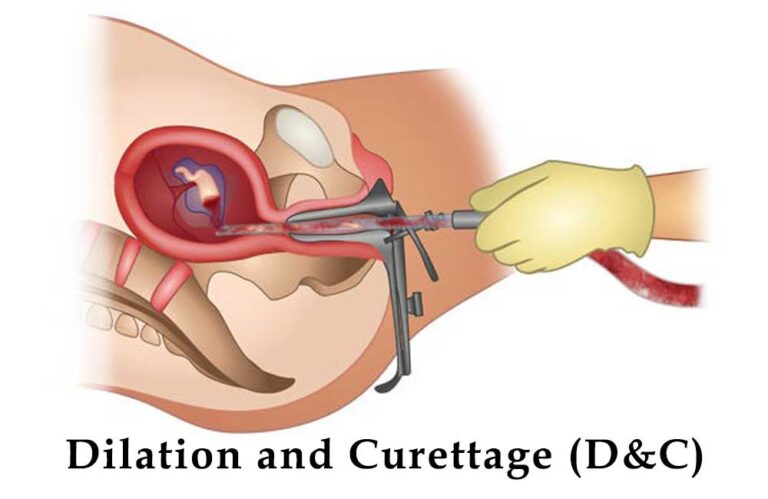 Dilation and Curettage (D&C): What You Need to Know About the Procedure and Recovery