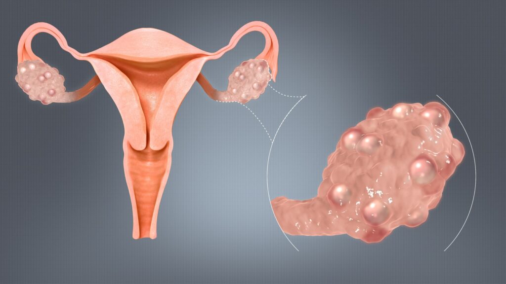 Polycystic Ovary Syndrome (PCOS) and Its Effects on Women