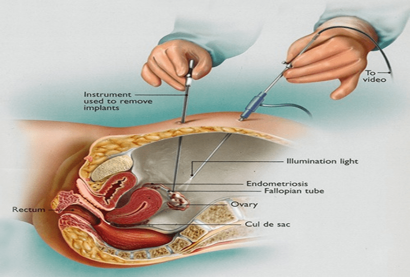 Laparoscopic Gynecological Surgeries: Benefits, Procedures, and Recovery